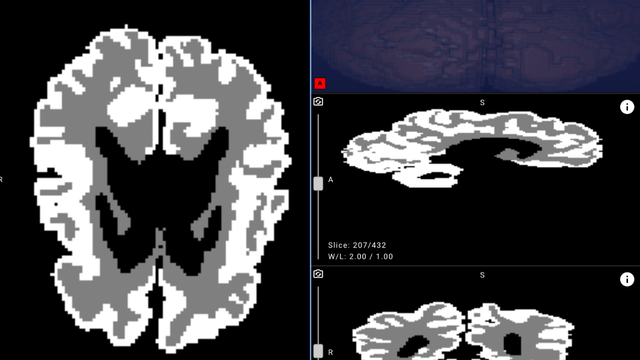 Bebek beynini analiz eden yapay zeka, erken teşhisi kolaylaştırıyor